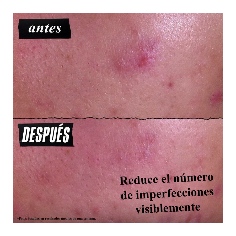 gently-effective-blemish-targeting-tratamiento-limpiador-acne